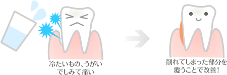 冷たいもの、うがいでしみて痛い場合は削れてしまった部分を覆うことで改善！