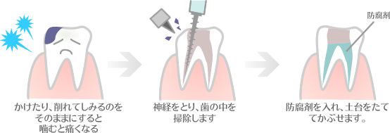 (1)かけたり、削れてしみるのをそのままにすると噛むと痛くなる。(2)神経をとり、歯の中を掃除します（3）防腐剤をいれ、土台をたててかぶせます。